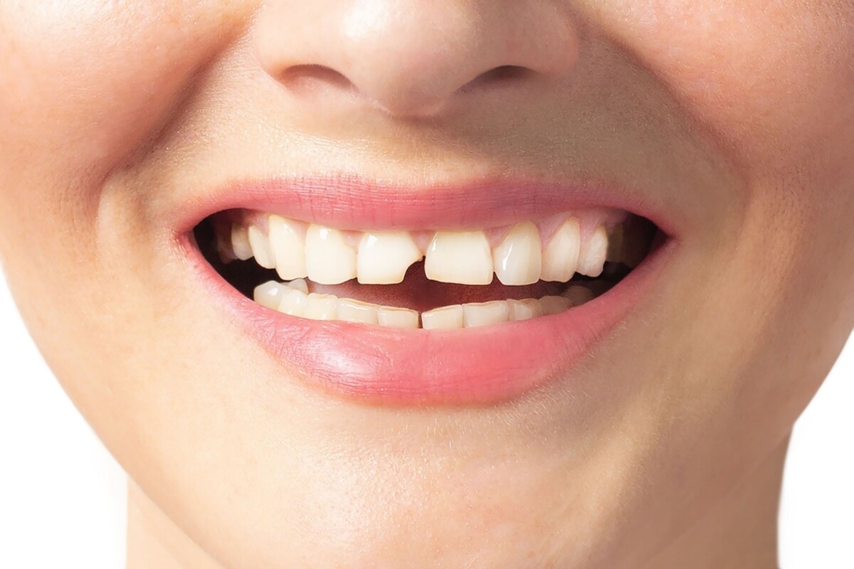 broken tooth how dental crowns can save your smile
