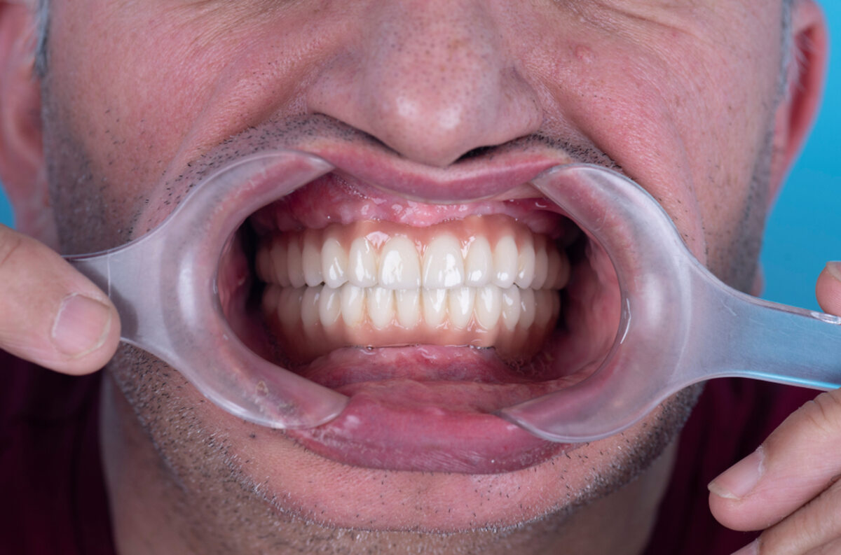 full mouth reconstruction